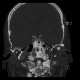 Osteoplastic metastases, prostate cancer: CT - Computed tomography
